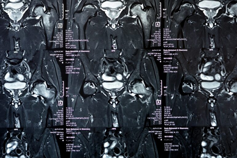 Οστικό-οίδημα-ισχίου
